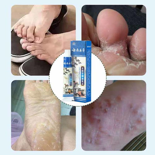 康凈衛(wèi)生用品 專業(yè)止癢噴劑廠家在線咨詢，您的個人衛(wèi)生守護者